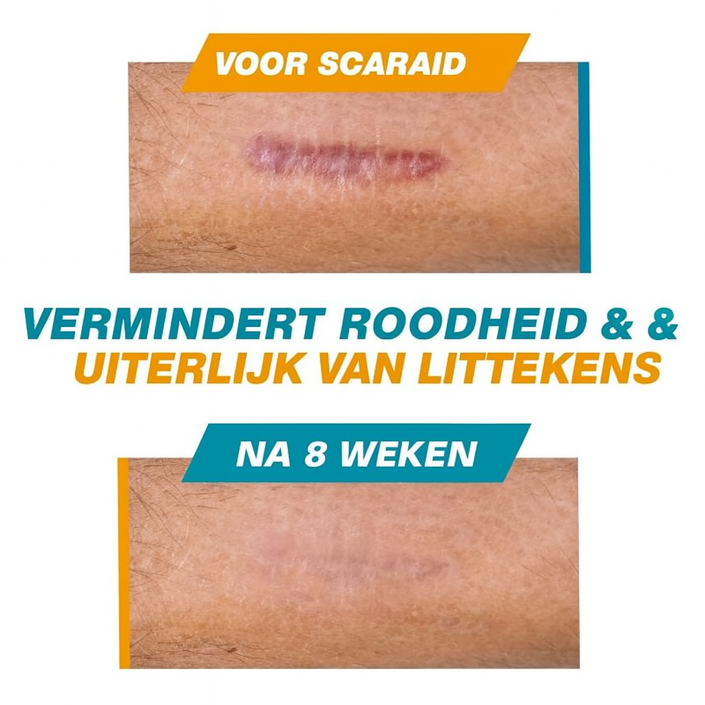 Skin Scar Solutions Siliconen Litteken Stick