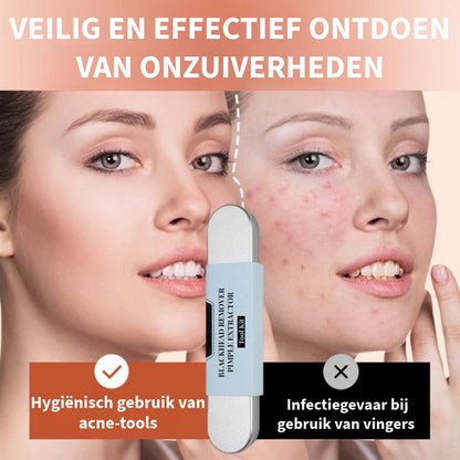 Professionele Mee-eter Verwijderingsset van Roestvrij Staal